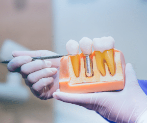 Dental-implants-hyderabad-dental-clinic
