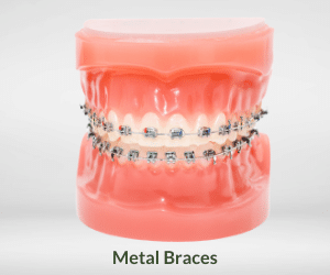 metal-braces-dentist-hyderabad