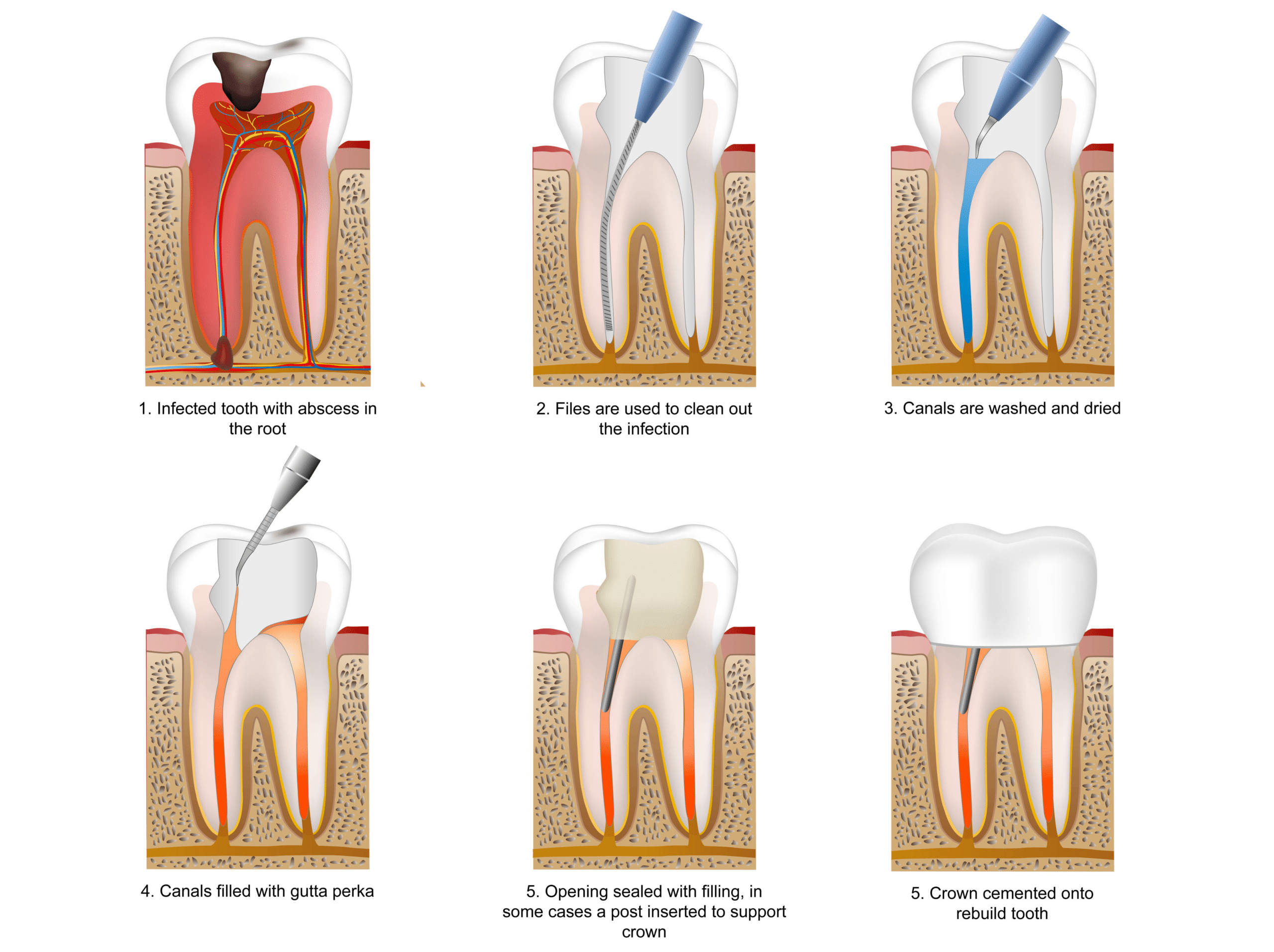 Root-Canal-treatment-hyderabad-dentist