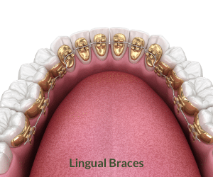 lingual-braces-dentist-hyderabad